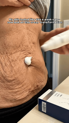 Cream applied to dry-looking skin